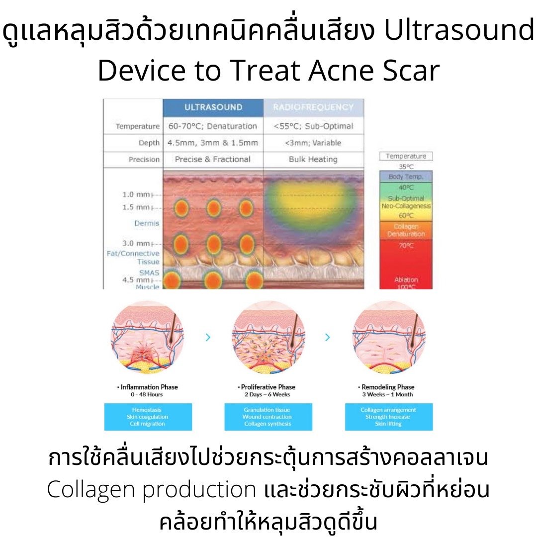 ดูแลหลุมสิวด้วยเทคนิคคลื่นเสียง Ultrasound Device to Treat Acne Scar ดูแลหลุมสิวด้วยเทคนิคคลื่นเสียง Ultrasound Device to Treat Acne Scar