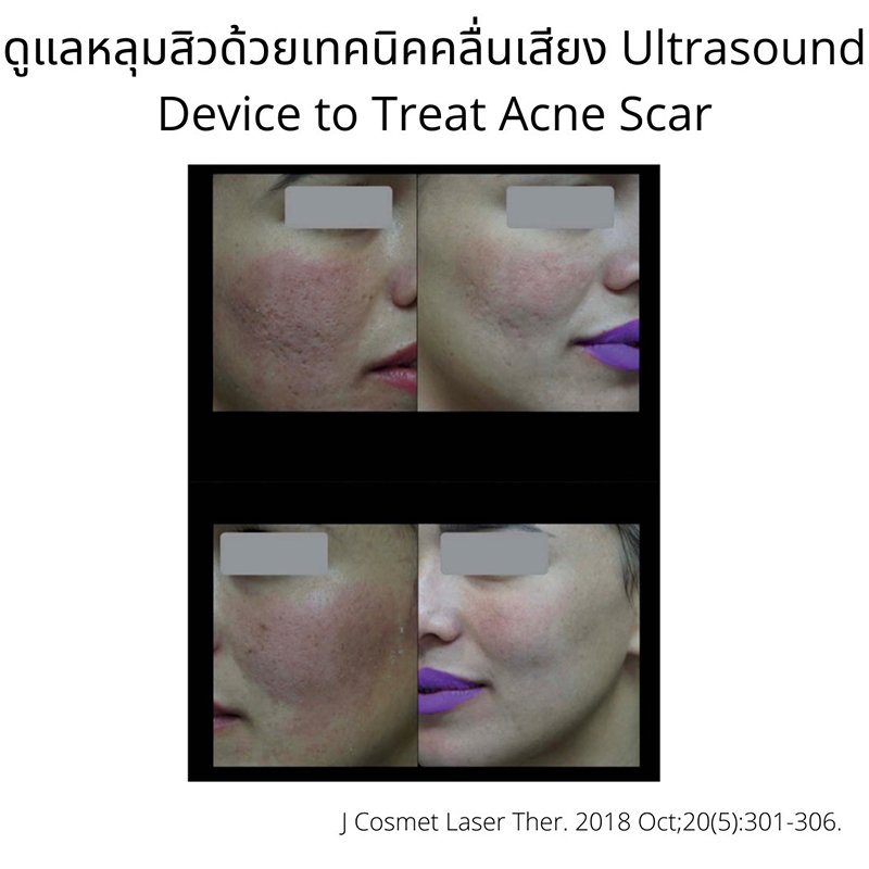 ดูแลหลุมสิวด้วยเทคนิคคลื่นเสียง Ultrasound Device to Treat Acne Scar ดูแลหลุมสิวด้วยเทคนิคคลื่นเสียง Ultrasound Device to Treat Acne Scar