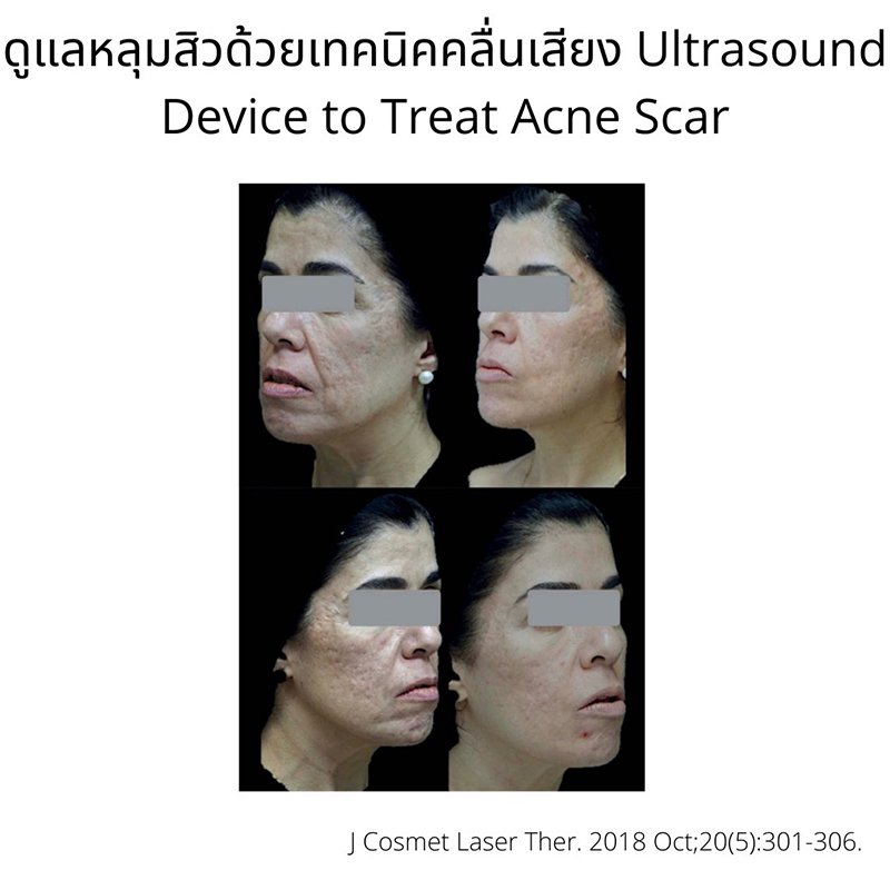 ดูแลหลุมสิวด้วยเทคนิคคลื่นเสียง Ultrasound Device to Treat Acne Scar ดูแลหลุมสิวด้วยเทคนิคคลื่นเสียง Ultrasound Device to Treat Acne Scar