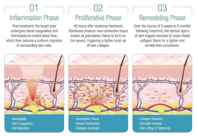ดูแลหลุมสิวด้วยเทคนิคคลื่นเสียง Ultrasound Device to Treat Acne Scar ดูแลหลุมสิวด้วยเทคนิคคลื่นเสียง Ultrasound Device to Treat Acne Scar