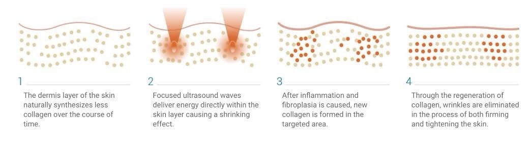 ดูแลหลุมสิวด้วยเทคนิคคลื่นเสียง Ultrasound Device to Treat Acne Scar ดูแลหลุมสิวด้วยเทคนิคคลื่นเสียง Ultrasound Device to Treat Acne Scar