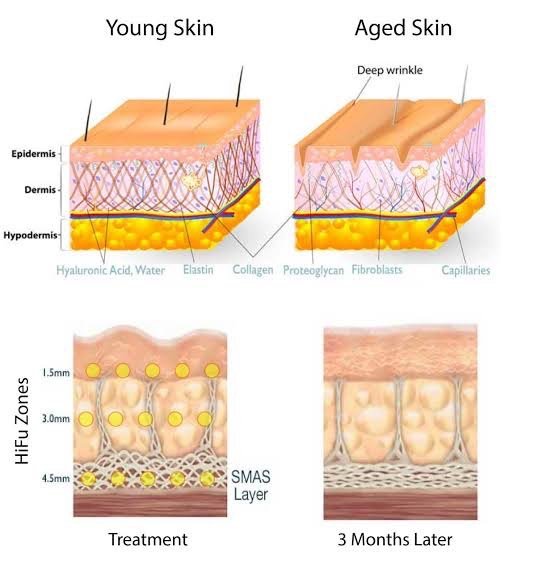 ดูแลหลุมสิวด้วยเทคนิคคลื่นเสียง Ultrasound Device to Treat Acne Scar ดูแลหลุมสิวด้วยเทคนิคคลื่นเสียง Ultrasound Device to Treat Acne Scar