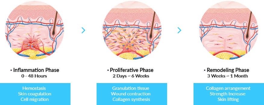 ดูแลหลุมสิวด้วยเทคนิคคลื่นเสียง Ultrasound Device to Treat Acne Scar ดูแลหลุมสิวด้วยเทคนิคคลื่นเสียง Ultrasound Device to Treat Acne Scar