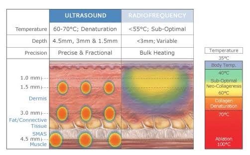 ดูแลหลุมสิวด้วยเทคนิคคลื่นเสียง Ultrasound Device to Treat Acne Scar ดูแลหลุมสิวด้วยเทคนิคคลื่นเสียง Ultrasound Device to Treat Acne Scar