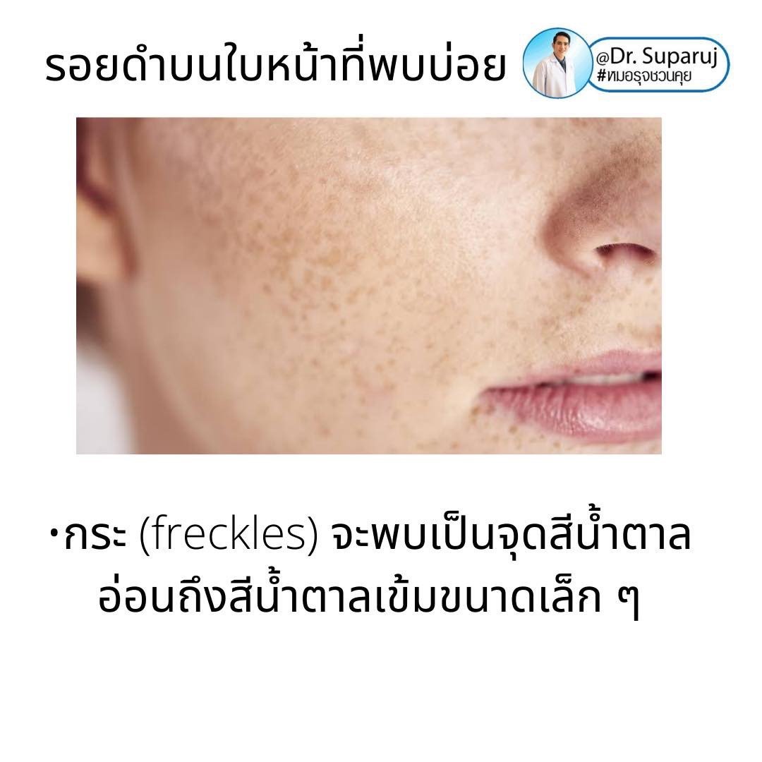 รอยดำที่หน้านอกจากเป็นฝ้า แล้วเป็นอะไรได้อีกบ้าง? รอยดำที่หน้านอกจากเป็นฝ้า แล้วเป็นอะไรได้อีกบ้าง?