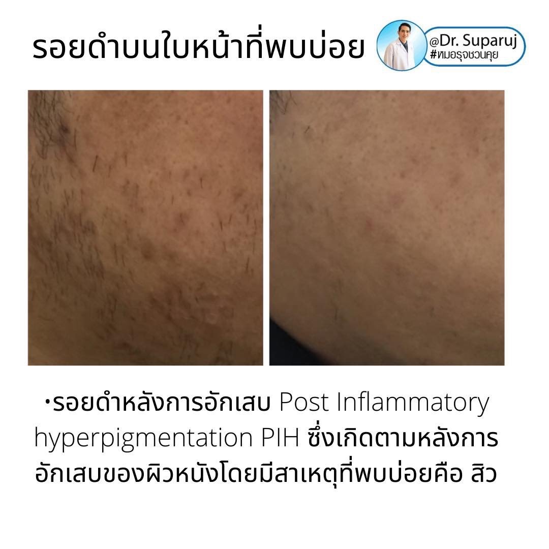 รอยดำที่หน้านอกจากเป็นฝ้า แล้วเป็นอะไรได้อีกบ้าง? รอยดำที่หน้านอกจากเป็นฝ้า แล้วเป็นอะไรได้อีกบ้าง?