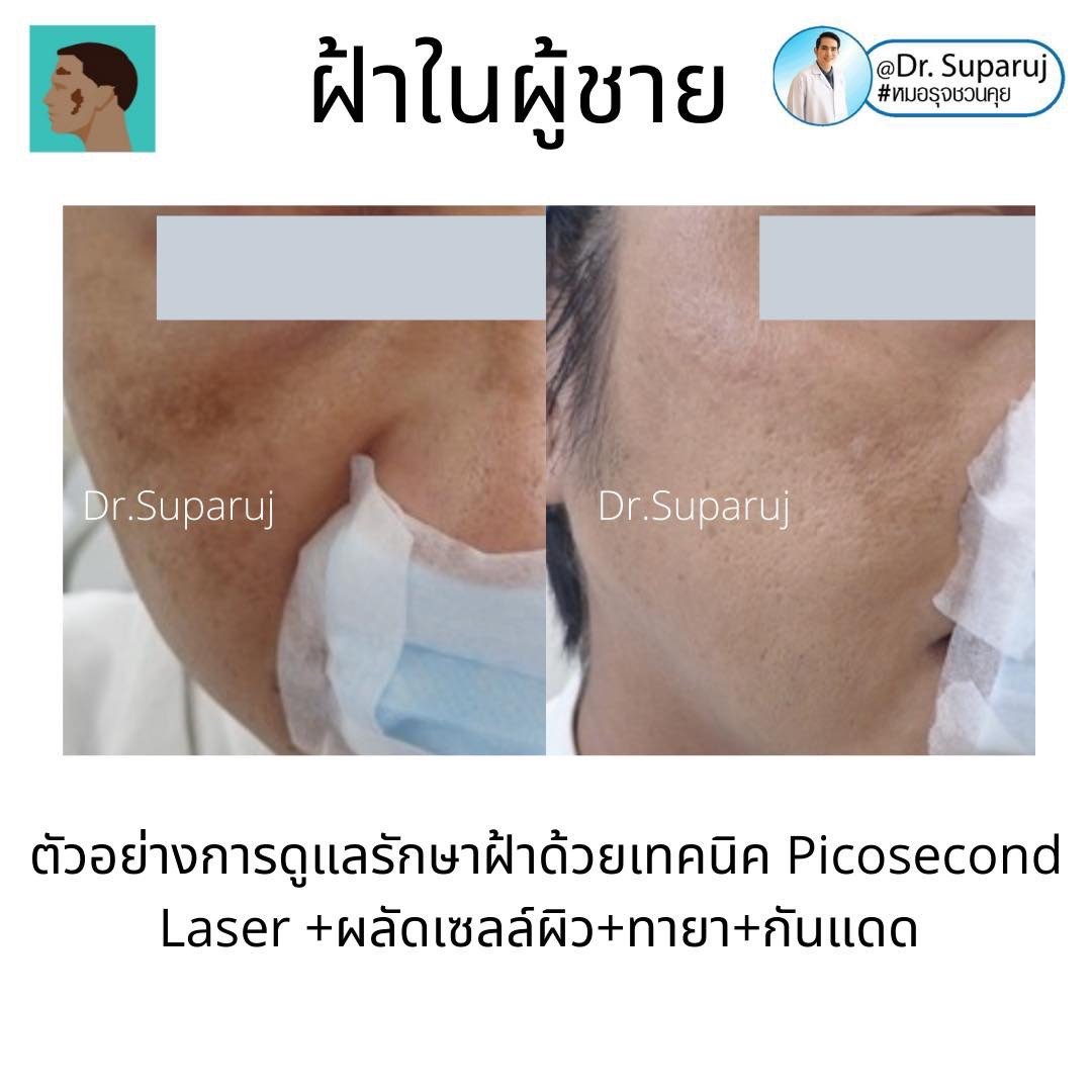 รอยดำที่หน้านอกจากเป็นฝ้า แล้วเป็นอะไรได้อีกบ้าง? รอยดำที่หน้านอกจากเป็นฝ้า แล้วเป็นอะไรได้อีกบ้าง?