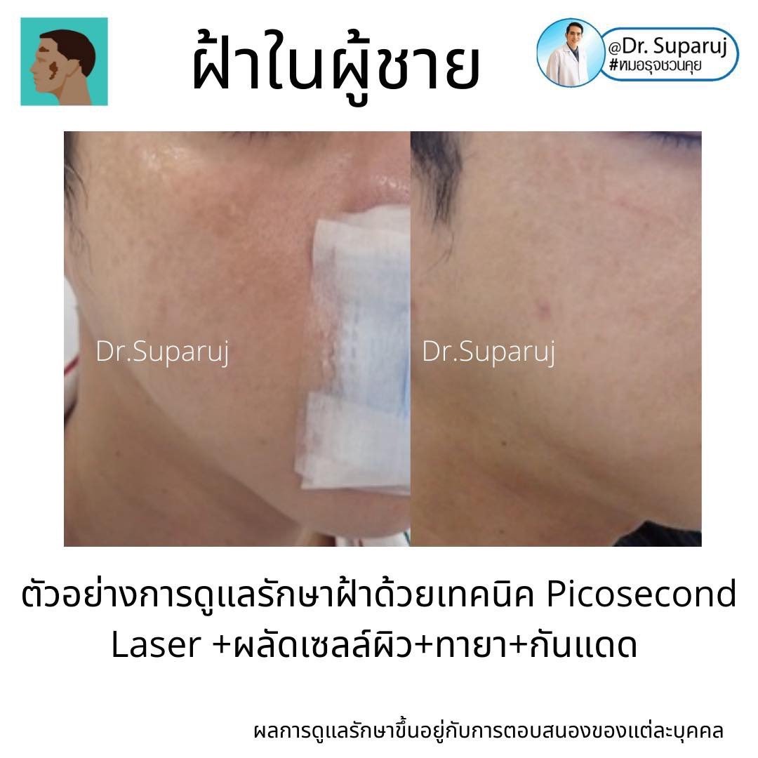 รอยดำที่หน้านอกจากเป็นฝ้า แล้วเป็นอะไรได้อีกบ้าง? รอยดำที่หน้านอกจากเป็นฝ้า แล้วเป็นอะไรได้อีกบ้าง?