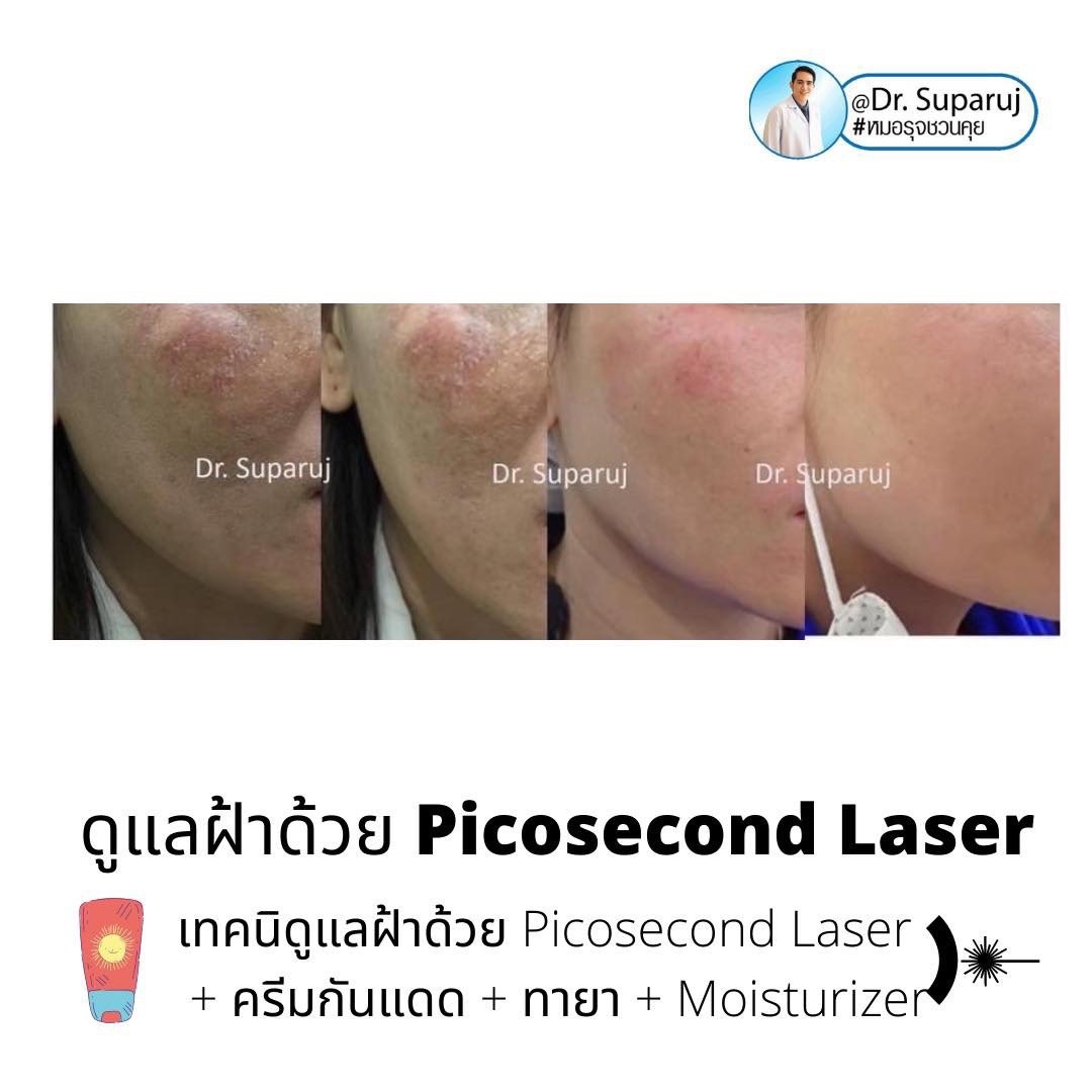 รอยดำที่หน้านอกจากเป็นฝ้า แล้วเป็นอะไรได้อีกบ้าง? รอยดำที่หน้านอกจากเป็นฝ้า แล้วเป็นอะไรได้อีกบ้าง?