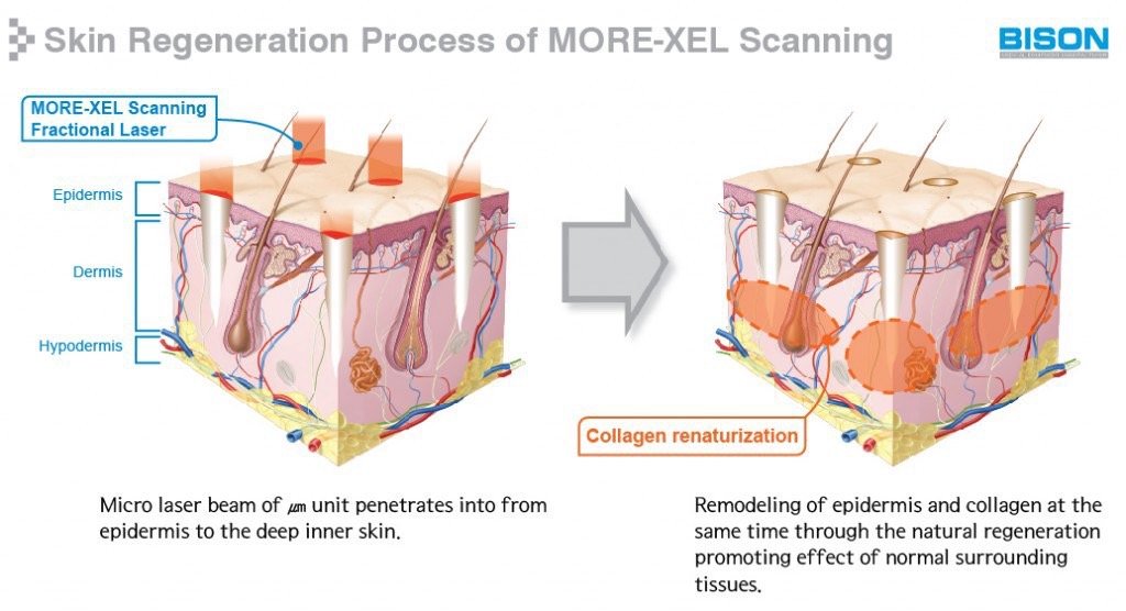 More-xel Scanning RF-Fractional Laser + CO2 Laser + Skin Analyzer เลเซอร์ดูแลแผลเป็น หลุมสิว รอยแตกลาย คีลอยด์