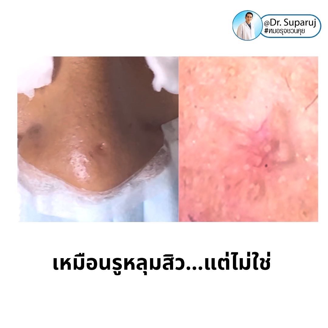 Dilated Pore of Winer เหมือนรูหลุมสิว...แต่ไม่ใช่