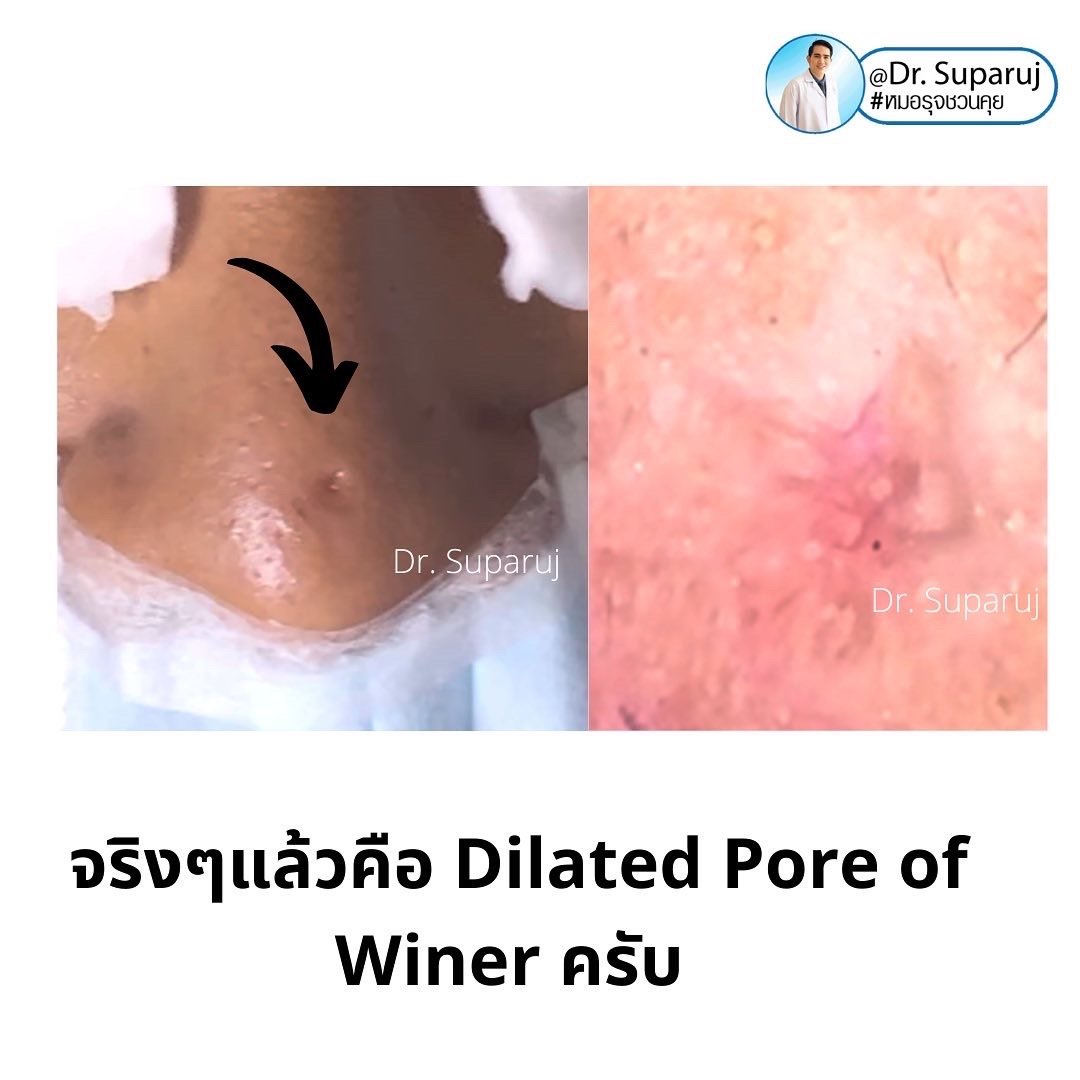 Dilated Pore of Winer เหมือนรูหลุมสิว...แต่ไม่ใช่ Dilated Pore of Winer เหมือนรูหลุมสิว...แต่ไม่ใช่