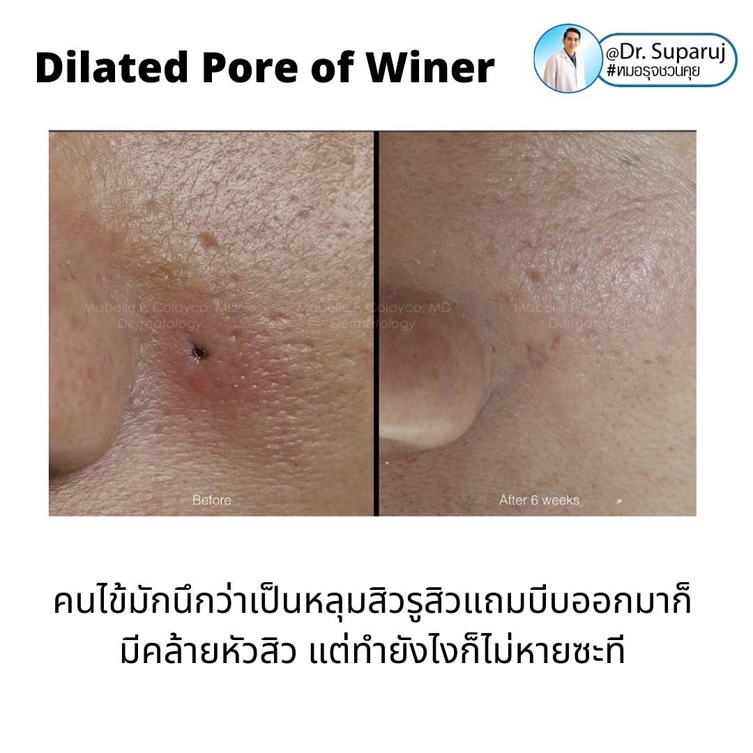 Dilated Pore of Winer เหมือนรูหลุมสิว...แต่ไม่ใช่ Dilated Pore of Winer เหมือนรูหลุมสิว...แต่ไม่ใช่