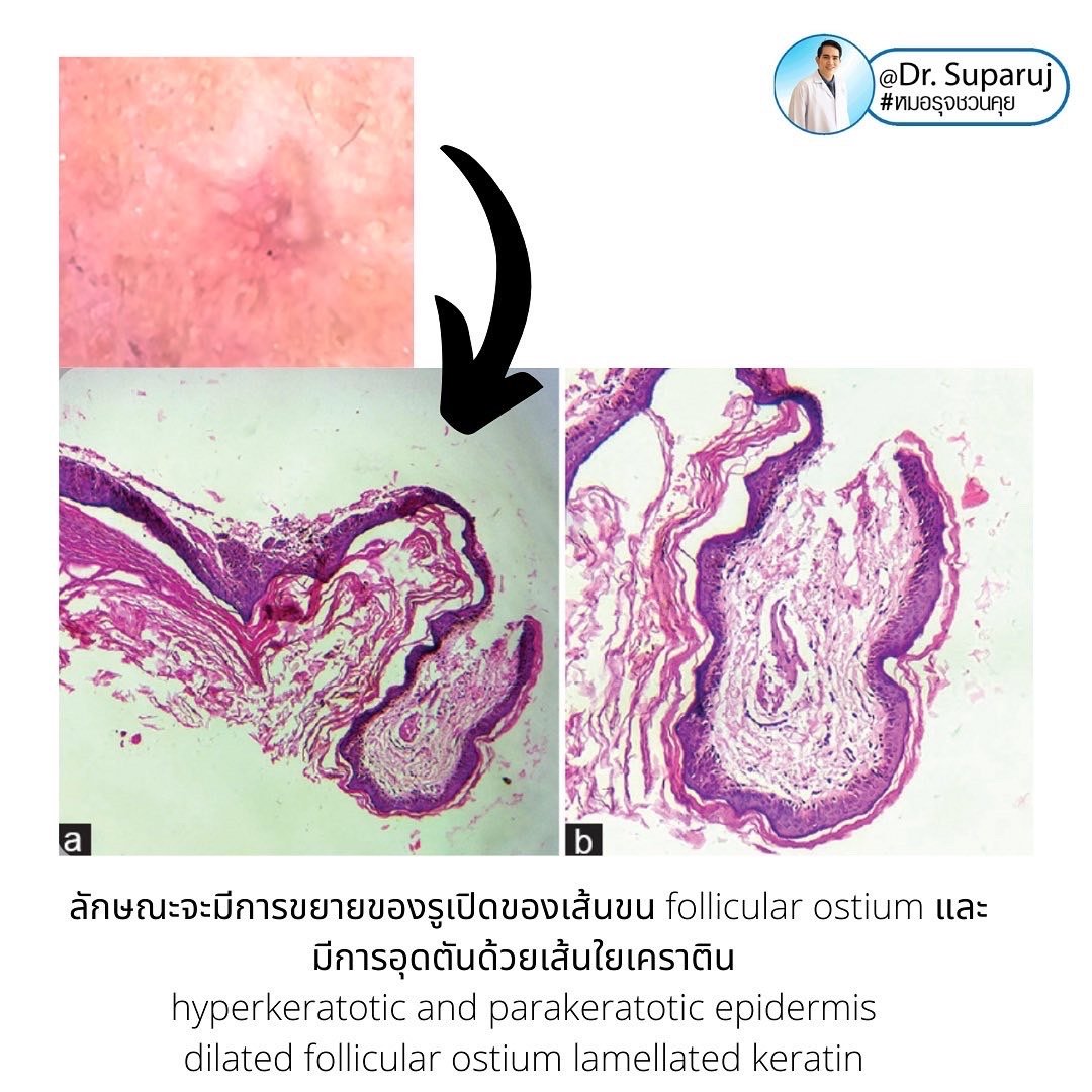 Dilated Pore of Winer เหมือนรูหลุมสิว...แต่ไม่ใช่ Dilated Pore of Winer เหมือนรูหลุมสิว...แต่ไม่ใช่