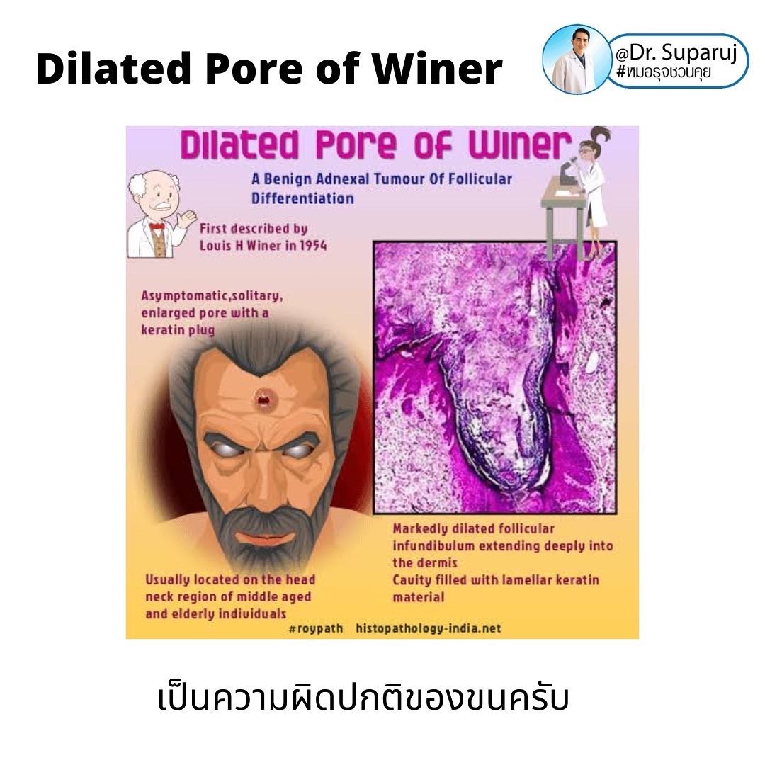Dilated Pore of Winer เหมือนรูหลุมสิว...แต่ไม่ใช่ Dilated Pore of Winer เหมือนรูหลุมสิว...แต่ไม่ใช่