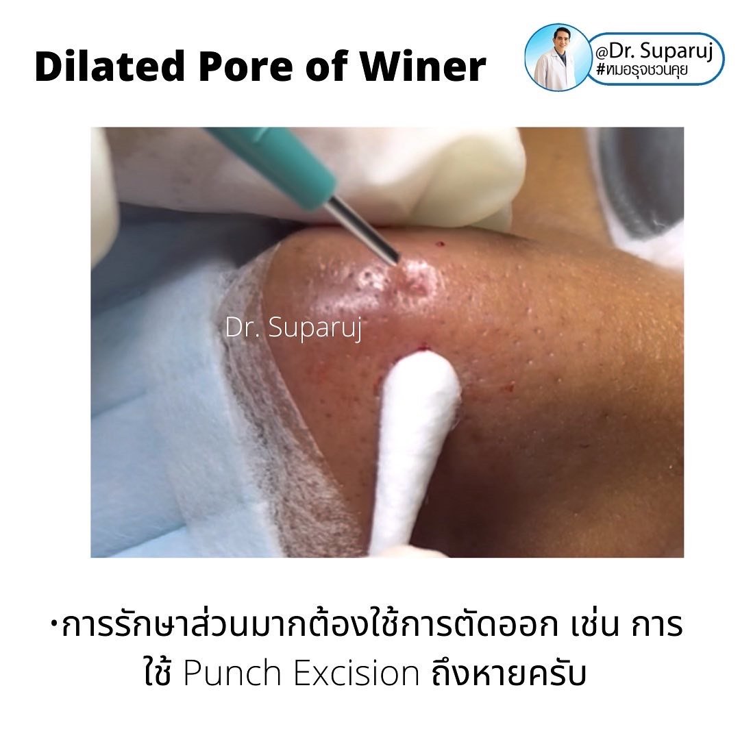 Dilated Pore of Winer เหมือนรูหลุมสิว...แต่ไม่ใช่ Dilated Pore of Winer เหมือนรูหลุมสิว...แต่ไม่ใช่