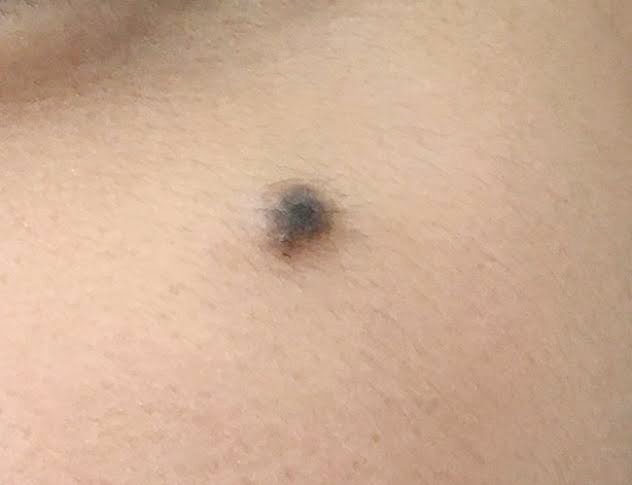 เทคนิคดูแลไฝและขี้แมลงวันด้วยเลเซอร์ Carbondioxide Laser (CO2 Laser) ร่วมกับกล้องส่องขยายพิเศษ Dermoscope เพื่อช่วยวินิจฉัยและรักษา เทคนิคดูแลไฝและขี้แมลงวันด้วยเลเซอร์ Carbondioxide Laser (CO2 Laser) ร่วมกับกล้องส่องขยายพิเศษ Dermoscope เพื่อช่วยวินิจฉัยและรักษา