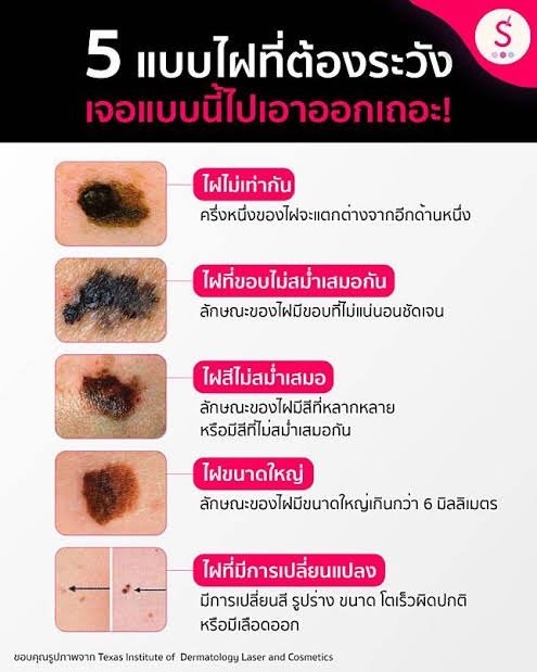 เทคนิคดูแลไฝและขี้แมลงวันด้วยเลเซอร์ Carbondioxide Laser (CO2 Laser) ร่วมกับกล้องส่องขยายพิเศษ Dermoscope เพื่อช่วยวินิจฉัยและรักษา เทคนิคดูแลไฝและขี้แมลงวันด้วยเลเซอร์ Carbondioxide Laser (CO2 Laser) ร่วมกับกล้องส่องขยายพิเศษ Dermoscope เพื่อช่วยวินิจฉัยและรักษาเทคนิคดูแลไฝและขี้แมลงวันด้วยเลเซอร์ Carbondioxide Laser (CO2 Laser) ร่วมกับกล้องส่องขยายพิเศษ Dermoscope เพื่อช่วยวินิจฉัยและรักษา