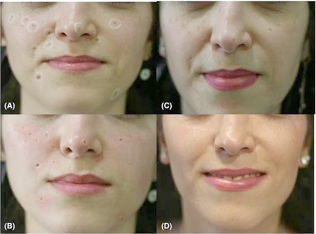 เทคนิคดูแลไฝและขี้แมลงวันด้วยเลเซอร์ Carbondioxide Laser (CO2 Laser) ร่วมกับกล้องส่องขยายพิเศษ Dermoscope เพื่อช่วยวินิจฉัยและรักษา เทคนิคดูแลไฝและขี้แมลงวันด้วยเลเซอร์ Carbondioxide Laser (CO2 Laser) ร่วมกับกล้องส่องขยายพิเศษ Dermoscope เพื่อช่วยวินิจฉัยและรักษา