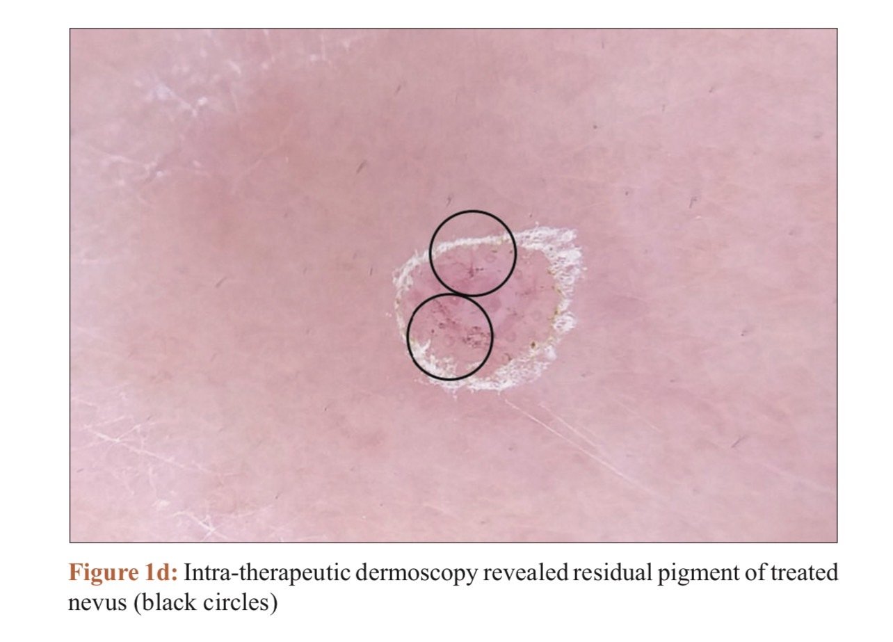 เทคนิคดูแลไฝและขี้แมลงวันด้วยเลเซอร์ Carbondioxide Laser (CO2 Laser) ร่วมกับกล้องส่องขยายพิเศษ Dermoscope เพื่อช่วยวินิจฉัยและรักษา เทคนิคดูแลไฝและขี้แมลงวันด้วยเลเซอร์ Carbondioxide Laser (CO2 Laser) ร่วมกับกล้องส่องขยายพิเศษ Dermoscope เพื่อช่วยวินิจฉัยและรักษา