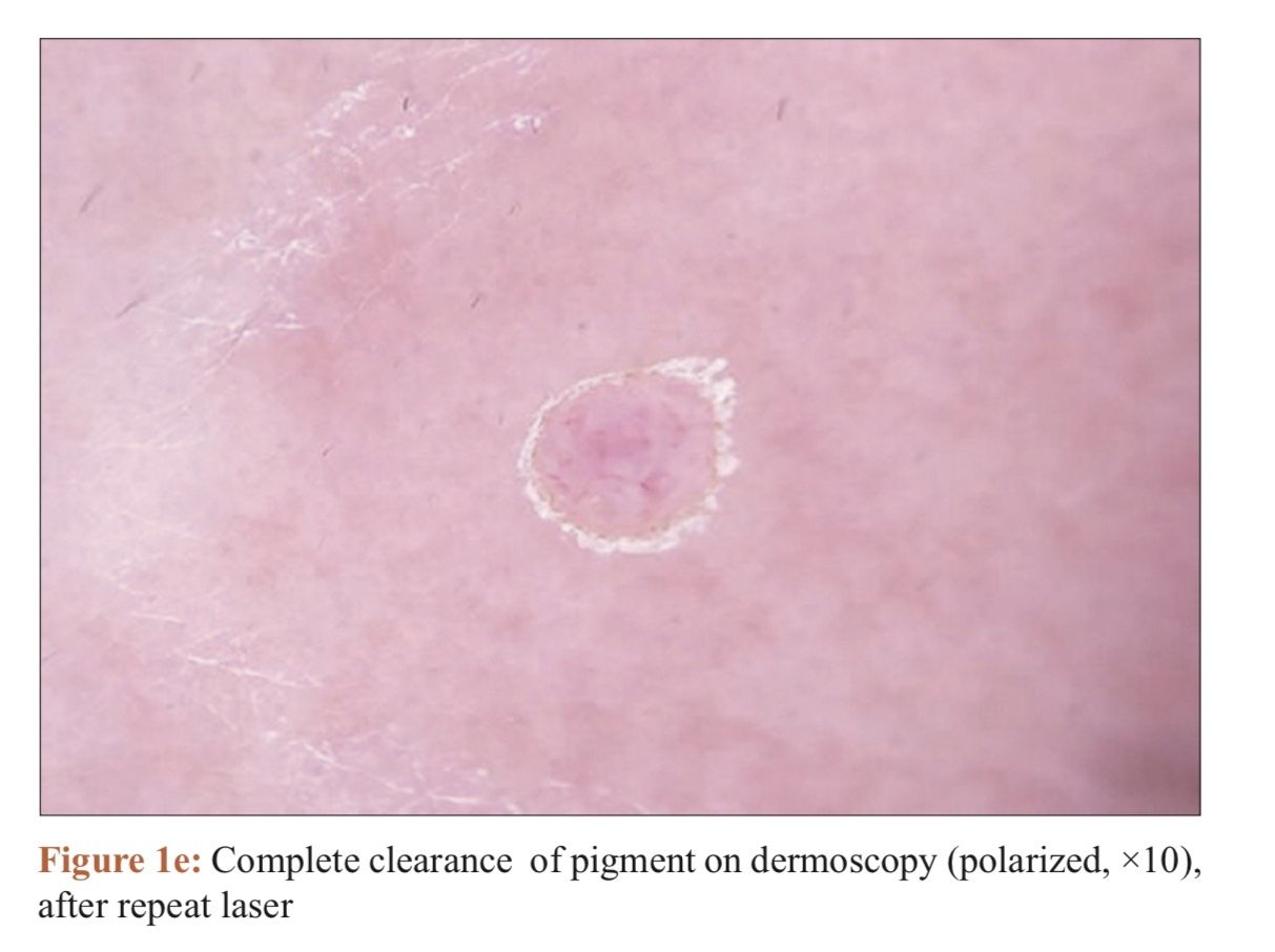 เทคนิคดูแลไฝและขี้แมลงวันด้วยเลเซอร์ Carbondioxide Laser (CO2 Laser) ร่วมกับกล้องส่องขยายพิเศษ Dermoscope เพื่อช่วยวินิจฉัยและรักษา เทคนิคดูแลไฝและขี้แมลงวันด้วยเลเซอร์ Carbondioxide Laser (CO2 Laser) ร่วมกับกล้องส่องขยายพิเศษ Dermoscope เพื่อช่วยวินิจฉัยและรักษา