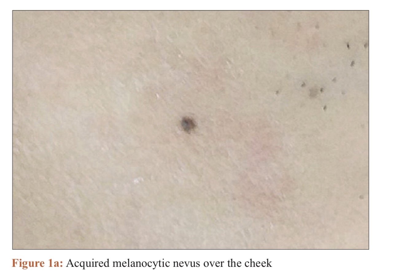 เทคนิคดูแลไฝและขี้แมลงวันด้วยเลเซอร์ Carbondioxide Laser (CO2 Laser) ร่วมกับกล้องส่องขยายพิเศษ Dermoscope เพื่อช่วยวินิจฉัยและรักษา เทคนิคดูแลไฝและขี้แมลงวันด้วยเลเซอร์ Carbondioxide Laser (CO2 Laser) ร่วมกับกล้องส่องขยายพิเศษ Dermoscope เพื่อช่วยวินิจฉัยและรักษา