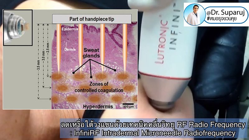 ลดเหงื่อใต้วงแขนด้วยเทคนิคคลื่นวิทยุ RF: InfiniRF Intradermal Microneedle Radiofrequency ลดเหงื่อใต้วงแขนด้วยเทคนิคคลื่นวิทยุ RF: InfiniRF Intradermal Microneedle Radiofrequency