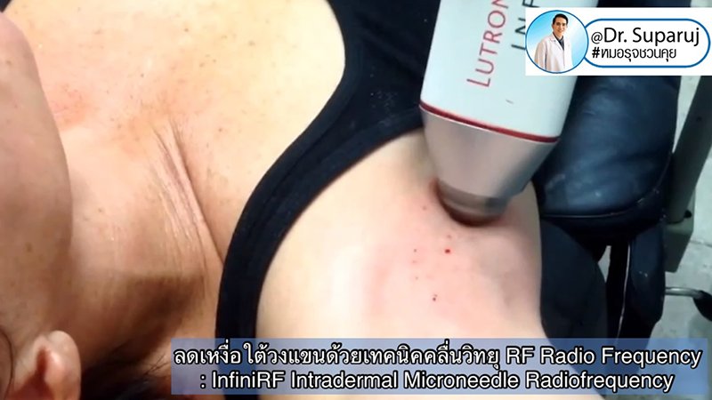 ลดเหงื่อใต้วงแขนด้วยเทคนิคคลื่นวิทยุ RF: InfiniRF Intradermal Microneedle Radiofrequency ลดเหงื่อใต้วงแขนด้วยเทคนิคคลื่นวิทยุ RF: InfiniRF Intradermal Microneedle Radiofrequency