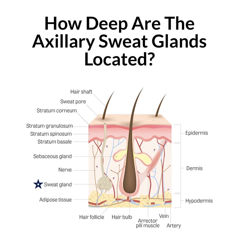 ลดเหงื่อใต้วงแขนด้วยเทคนิคคลื่นวิทยุ RF: InfiniRF Intradermal Microneedle Radiofrequency ลดเหงื่อใต้วงแขนด้วยเทคนิคคลื่นวิทยุ RF: InfiniRF Intradermal Microneedle Radiofrequency