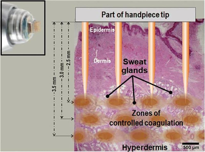ลดเหงื่อใต้วงแขนด้วยเทคนิคคลื่นวิทยุ RF: InfiniRF Intradermal Microneedle Radiofrequency ลดเหงื่อใต้วงแขนด้วยเทคนิคคลื่นวิทยุ RF: InfiniRF Intradermal Microneedle Radiofrequency
