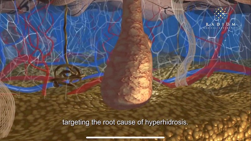 ลดเหงื่อใต้วงแขนด้วยเทคนิคคลื่นวิทยุ RF: InfiniRF Intradermal Microneedle Radiofrequency ลดเหงื่อใต้วงแขนด้วยเทคนิคคลื่นวิทยุ RF: InfiniRF Intradermal Microneedle Radiofrequency