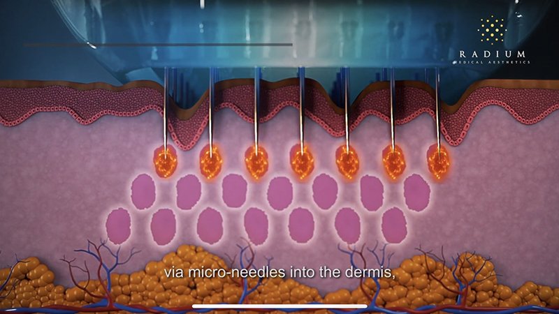 ลดเหงื่อใต้วงแขนด้วยเทคนิคคลื่นวิทยุ RF: InfiniRF Intradermal Microneedle Radiofrequency ลดเหงื่อใต้วงแขนด้วยเทคนิคคลื่นวิทยุ RF: InfiniRF Intradermal Microneedle Radiofrequency