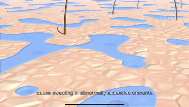 ลดเหงื่อใต้วงแขนด้วยเทคนิคคลื่นวิทยุ RF: InfiniRF Intradermal Microneedle Radiofrequency ลดเหงื่อใต้วงแขนด้วยเทคนิคคลื่นวิทยุ RF: InfiniRF Intradermal Microneedle Radiofrequency