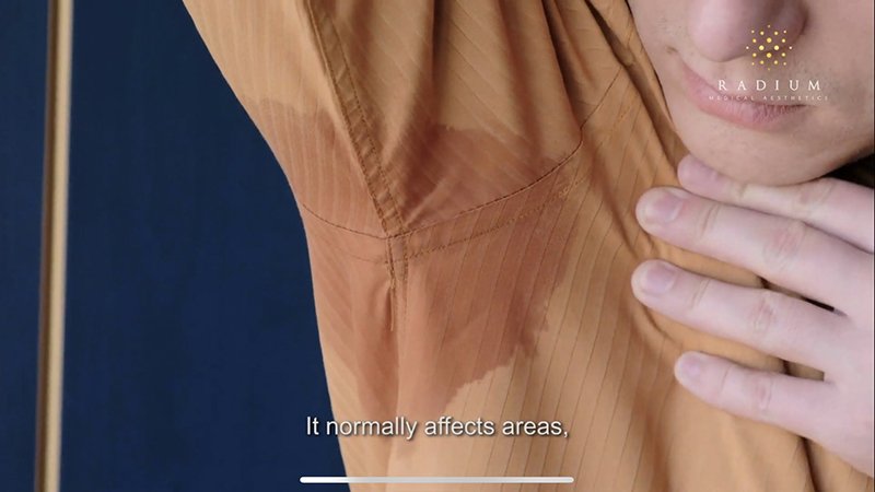 ลดเหงื่อใต้วงแขนด้วยเทคนิคคลื่นวิทยุ RF: InfiniRF Intradermal Microneedle Radiofrequency ลดเหงื่อใต้วงแขนด้วยเทคนิคคลื่นวิทยุ RF: InfiniRF Intradermal Microneedle Radiofrequency