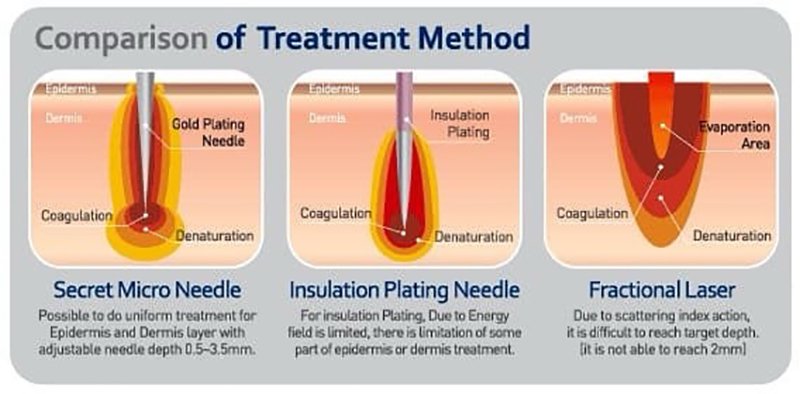 ลดเหงื่อใต้วงแขนด้วยเทคนิคคลื่นวิทยุ RF: InfiniRF Intradermal Microneedle Radiofrequency ลดเหงื่อใต้วงแขนด้วยเทคนิคคลื่นวิทยุ RF: InfiniRF Intradermal Microneedle Radiofrequency
