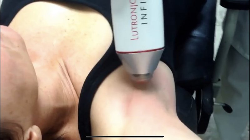 ลดเหงื่อใต้วงแขนด้วยเทคนิคคลื่นวิทยุ RF: InfiniRF Intradermal Microneedle Radiofrequency ลดเหงื่อใต้วงแขนด้วยเทคนิคคลื่นวิทยุ RF: InfiniRF Intradermal Microneedle Radiofrequency