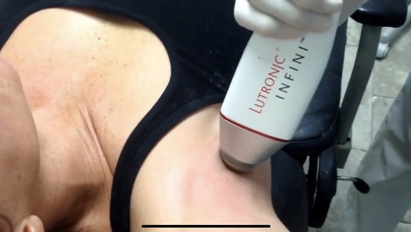 ลดเหงื่อใต้วงแขนด้วยเทคนิคคลื่นวิทยุ RF: InfiniRF Intradermal Microneedle Radiofrequency ลดเหงื่อใต้วงแขนด้วยเทคนิคคลื่นวิทยุ RF: InfiniRF Intradermal Microneedle Radiofrequency