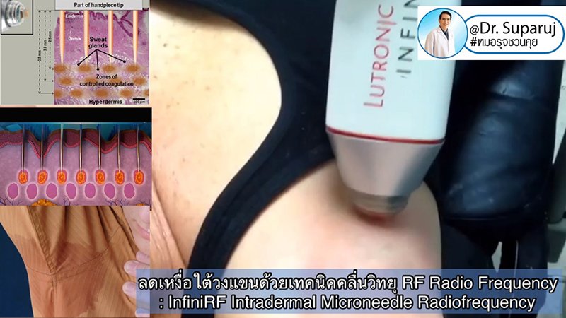 ลดเหงื่อใต้วงแขนด้วยเทคนิคคลื่นวิทยุ RF: InfiniRF Intradermal Microneedle Radiofrequency ลดเหงื่อใต้วงแขนด้วยเทคนิคคลื่นวิทยุ RF: InfiniRF Intradermal Microneedle Radiofrequency
