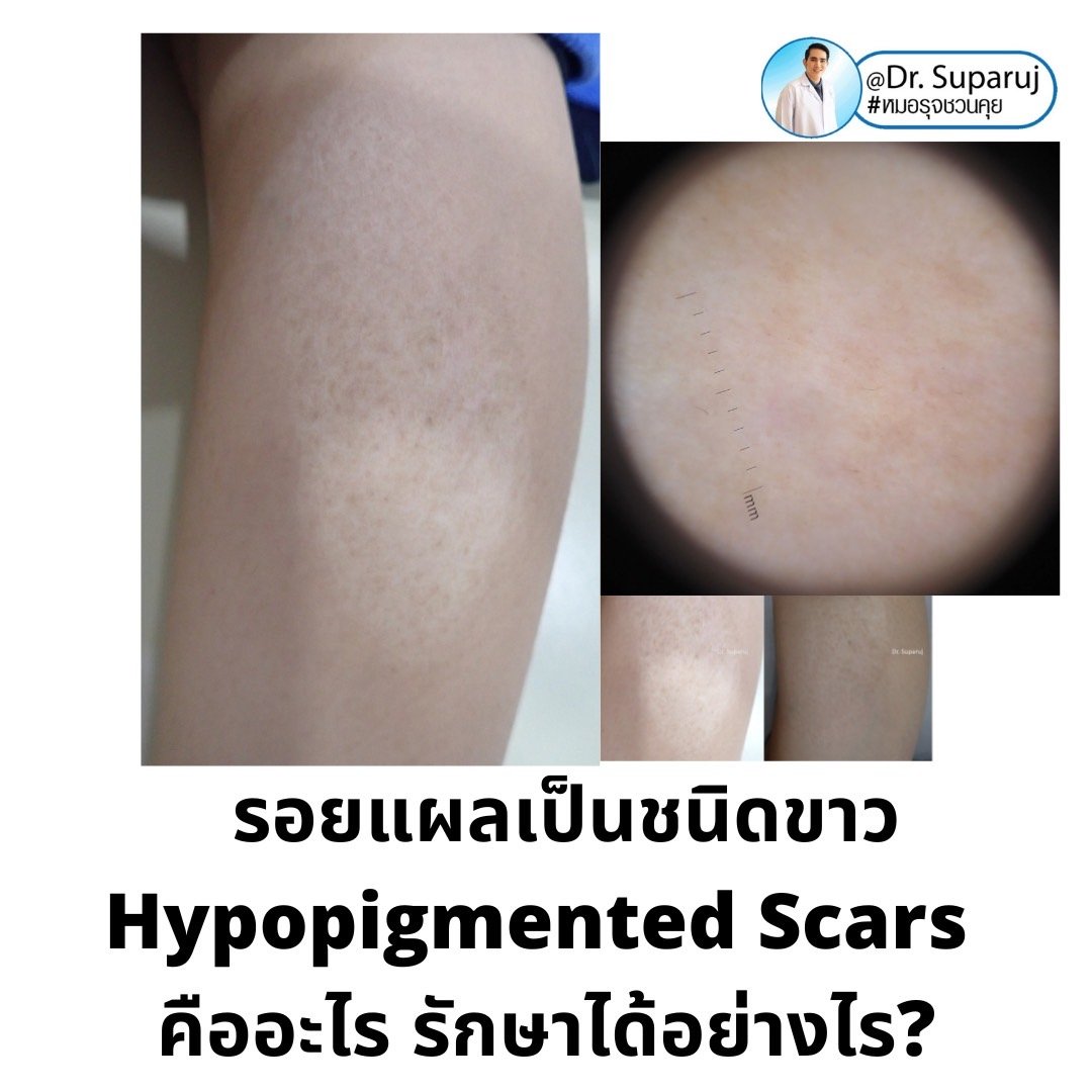 รอยแผลเป็นชนิดขาว Hypopigmented Scars คืออะไร รักษาได้อย่างไร?