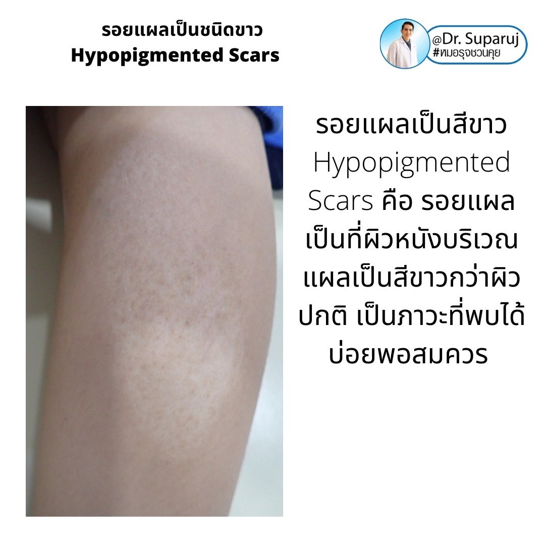 รอยแผลเป็นชนิดขาว Hypopigmented Scars คืออะไร รักษาได้อย่างไร?