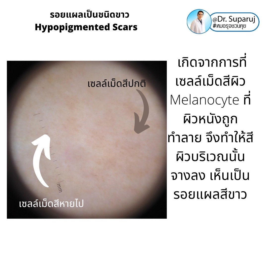 รอยแผลเป็นชนิดขาว Hypopigmented Scars คืออะไร รักษาได้อย่างไร?