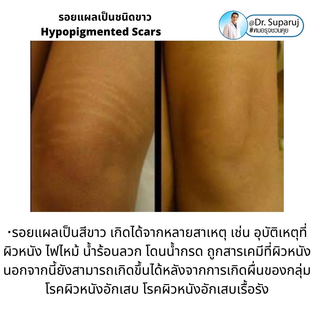 รอยแผลเป็นชนิดขาว Hypopigmented Scars คืออะไร รักษาได้อย่างไร? รอยแผลเป็นชนิดขาว Hypopigmented Scars คืออะไร รักษาได้อย่างไร?
