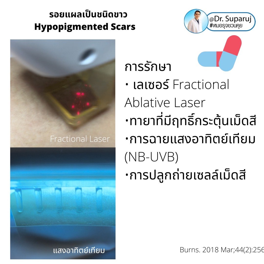 รอยแผลเป็นชนิดขาว Hypopigmented Scars คืออะไร รักษาได้อย่างไร?