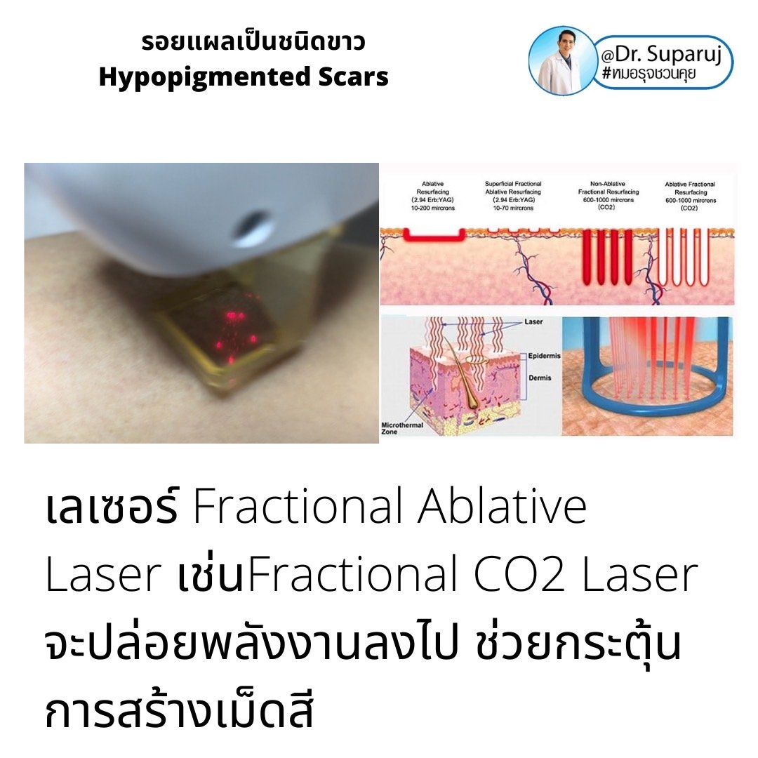 รอยแผลเป็นชนิดขาว Hypopigmented Scars คืออะไร รักษาได้อย่างไร? รอยแผลเป็นชนิดขาว Hypopigmented Scars คืออะไร รักษาได้อย่างไร?