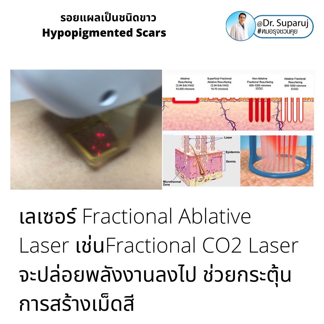 รอยแผลเป็นชนิดขาว Hypopigmented Scars คืออะไร รักษาได้อย่างไร?