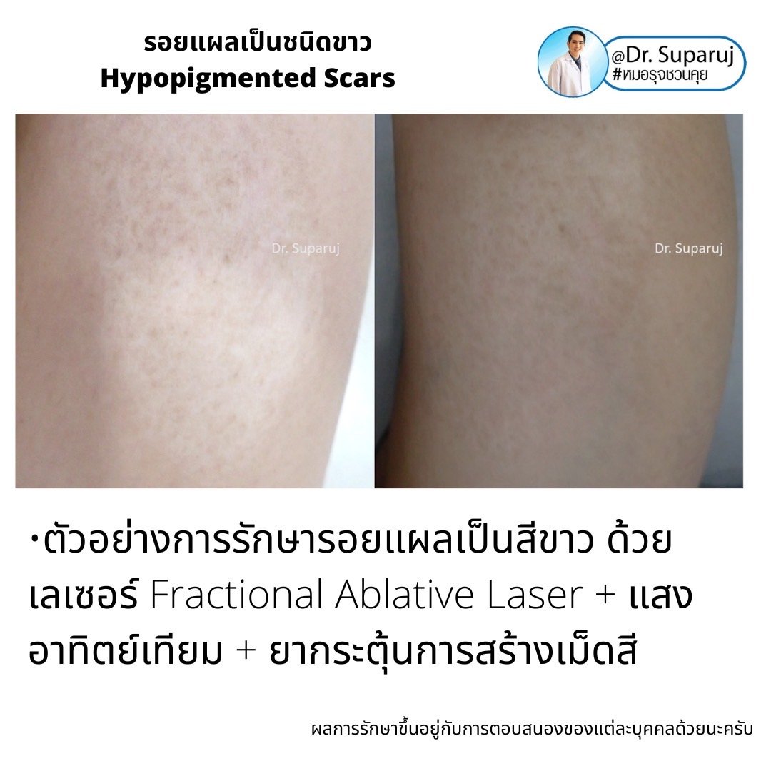 รอยแผลเป็นชนิดขาว Hypopigmented Scars คืออะไร รักษาได้อย่างไร? รอยแผลเป็นชนิดขาว Hypopigmented Scars คืออะไร รักษาได้อย่างไร?
