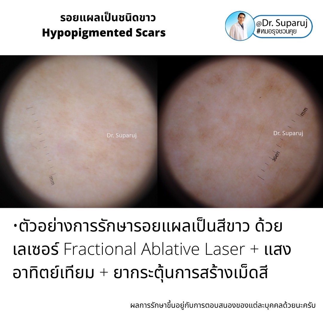 รอยแผลเป็นชนิดขาว Hypopigmented Scars คืออะไร รักษาได้อย่างไร?