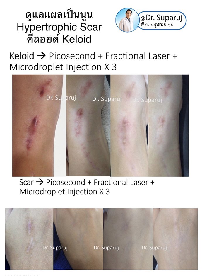 ดูแลแผลเป็นนูน คีลอยด์ ด้วยเทคนิค Triple Laser Therapy: Picosecond Laser + Gold Toning + Fractional Laser + ฉีดยา Intralesional In ดูแลแผลเป็นนูน คีลอยด์ ด้วยเทคนิค Triple Laser Therapy: Picosecond Laser + Gold Toning + Fractional Laser + ฉีดยา Intralesional In