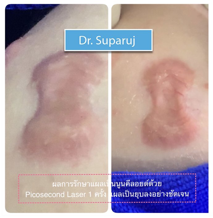 ดูแลแผลเป็นนูน คีลอยด์ ด้วยเทคนิค Triple Laser Therapy: Picosecond Laser + Gold Toning + Fractional Laser + ฉีดยา Intralesional In ดูแลแผลเป็นนูน คีลอยด์ ด้วยเทคนิค Triple Laser Therapy: Picosecond Laser + Gold Toning + Fractional Laser + ฉีดยา Intralesional In