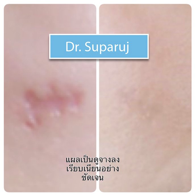 ดูแลแผลเป็นนูน คีลอยด์ ด้วยเทคนิค Triple Laser Therapy: Picosecond Laser + Gold Toning + Fractional Laser + ฉีดยา Intralesional In ดูแลแผลเป็นนูน คีลอยด์ ด้วยเทคนิค Triple Laser Therapy: Picosecond Laser + Gold Toning + Fractional Laser + ฉีดยา Intralesional In